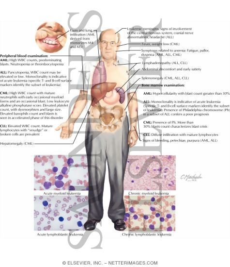 Leukemias