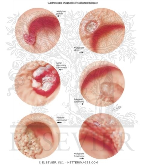 Watermarked preview of labeled image: Gastroscopic Diagnosis of Malignant Disease