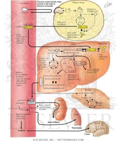 Diabetic Ketoacidosis