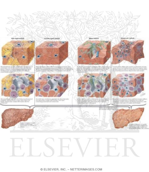 Watermarked preview of labeled image: Cirrhosis I - Pathways of Formation