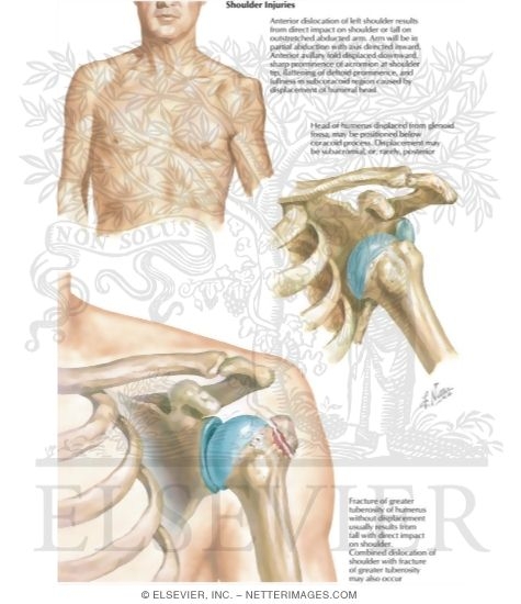 Watermarked preview of labeled image: Shoulder Injuries