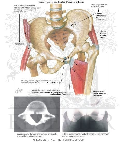 Watermarked preview of labeled image: Stress Fracture and Related Disorders of the Pelvis