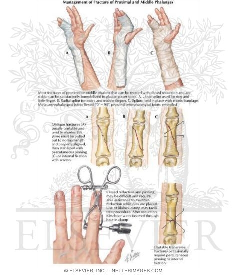 Management of Fracture of Proximal and Middle Phalanges