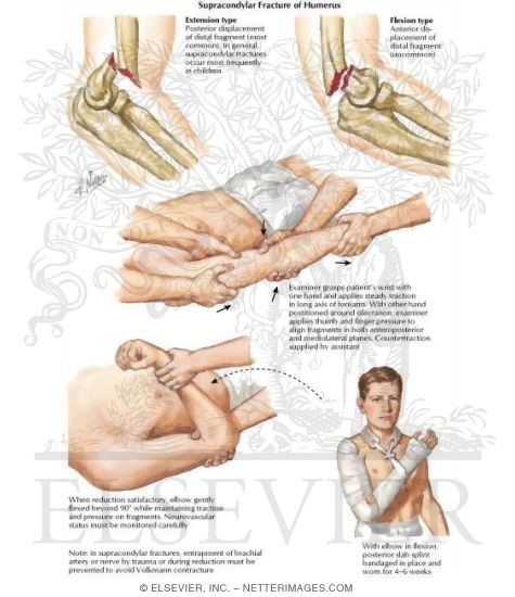 Supracondylar Fracture of Humerus