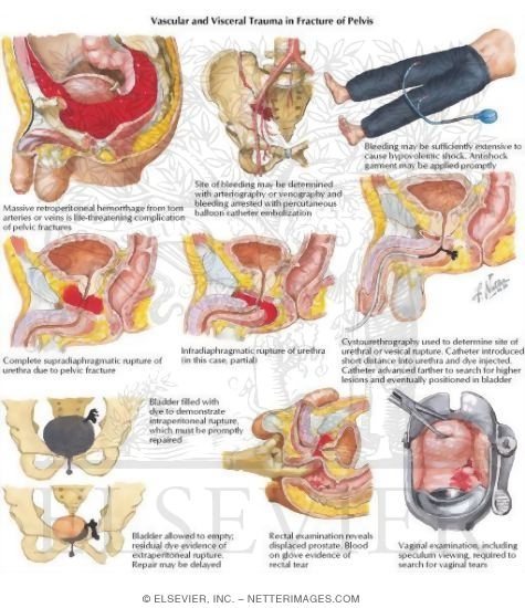 Vascular and Visceral Trauma in Fracture of Pelvis