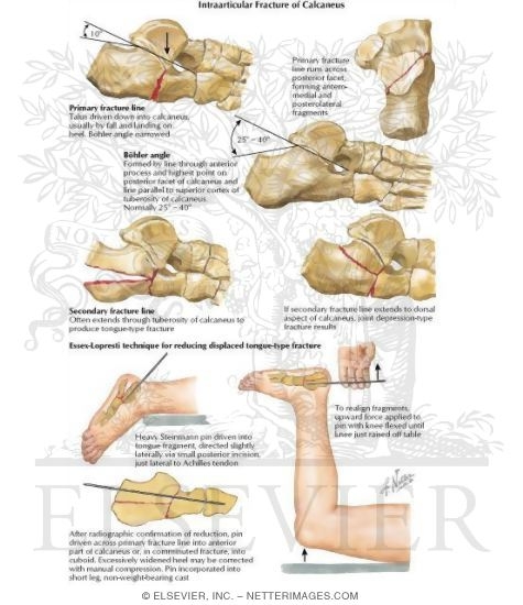 Intraarticular Fracture of Calcaneus