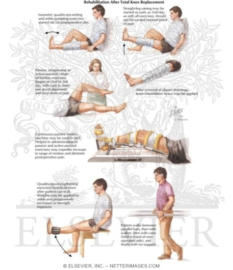 Rehabilitation After Total Knee Replacement