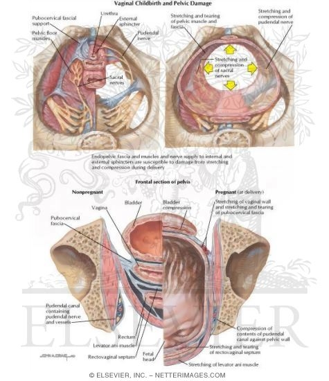 Watermarked preview of labeled image: Vaginal Childbirth and Pelvic Damage