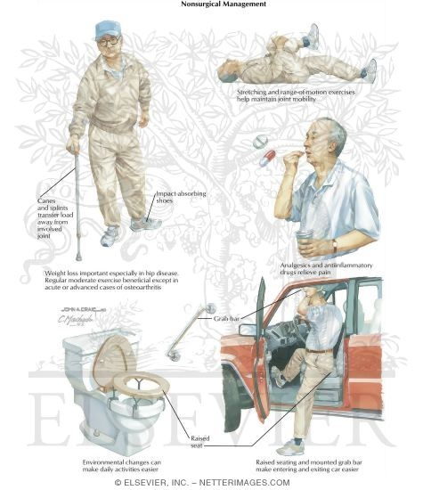 Watermarked preview of labeled image: Nonsurgical Management of Degenerative Joint Disease (DJD)