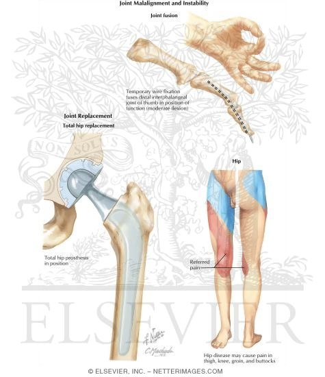 Watermarked preview of labeled image: Joint Malalignment and Instability