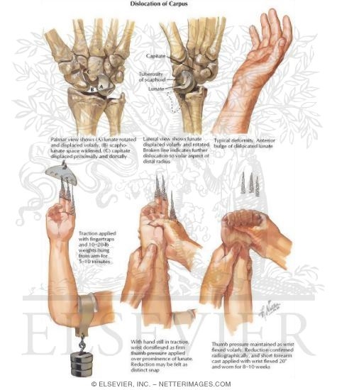 Watermarked preview of labeled image: Dislocation of Carpus