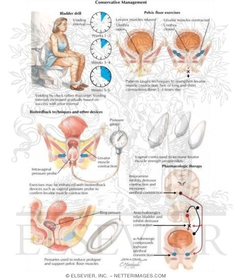 Watermarked preview of labeled image: Conservative Management
Pessary Therapy