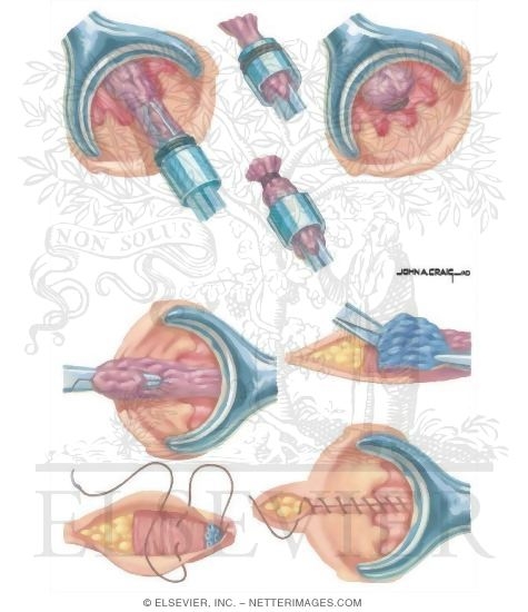 Watermarked preview of unlabeled image: Anorectal Disorders: Surgical Management of Internal Hemorrhoids