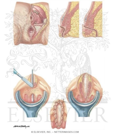 Watermarked preview of unlabeled image: Anorectal Disorders: Surgical Management of Fisutla-ano
