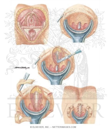 Anorectal Disorders: Surgical Management of Horseshoe Fistula