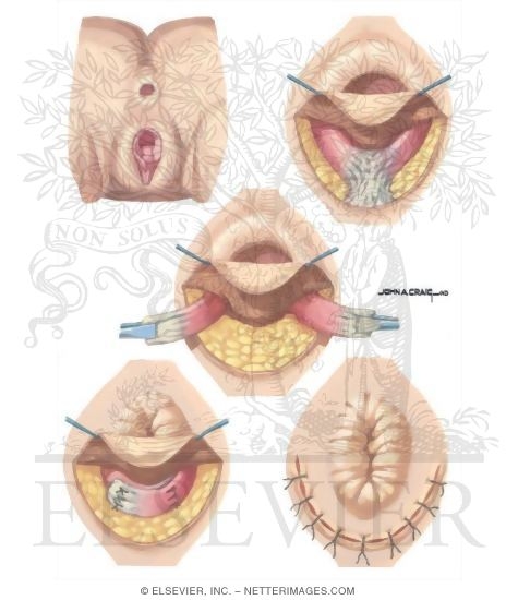 Anorectal Disorders: Sphincter Repair Technique