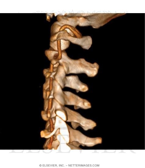 Watermarked preview of unlabeled image: Vertebral Artery, Neck