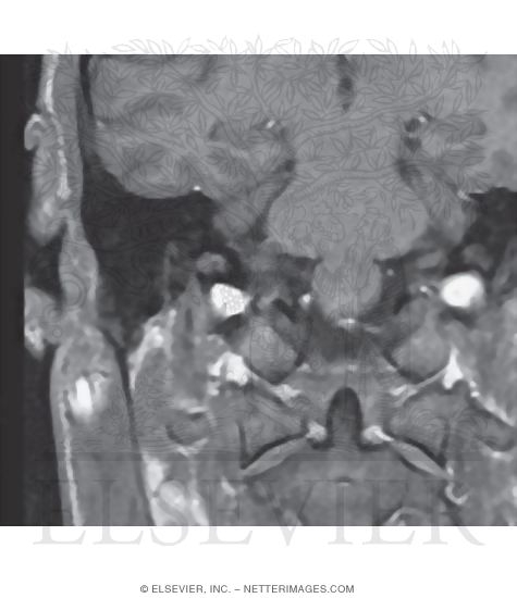 Watermarked preview of unlabeled image: Facial Nerve In Canal