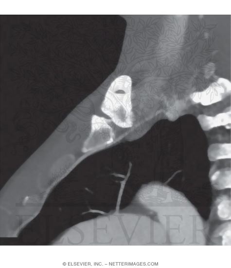 Watermarked preview of unlabeled image: Right Subclavian Artery, Origin