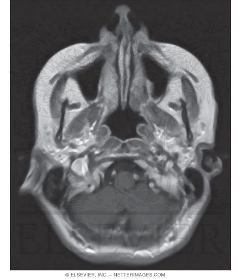 Nose and Paranasal Sinuses