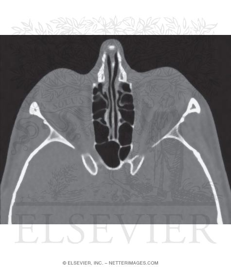 Ethmoid Air Cells and Sphenoid Sinus