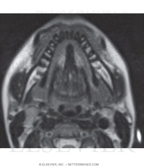 Watermarked preview of unlabeled image: Floor of Mouth
