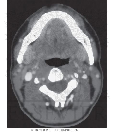 Submandibular and Sublingual Salivary Glands