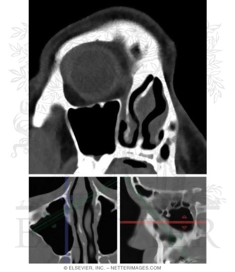 Nasolacrimal Duct