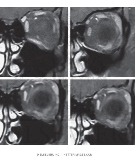 Watermarked preview of unlabeled image: Orbit, Coronal Section