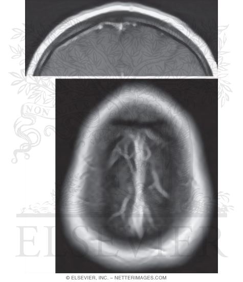 Superior Sagittal Sinus