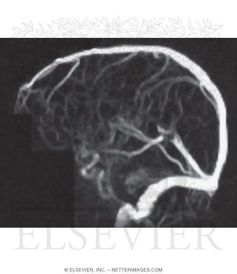 Cerebral Venous Sinuses