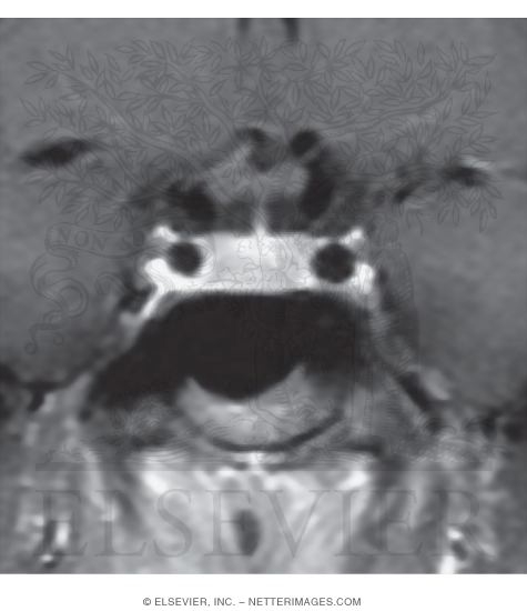 Cavernous Sinus