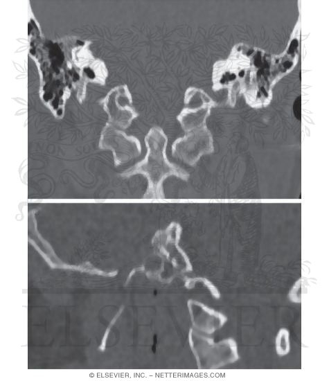 Hypoglossal Nerve (XII) and Canal