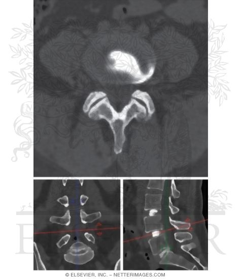 Structure of Lumbar Vertebrae