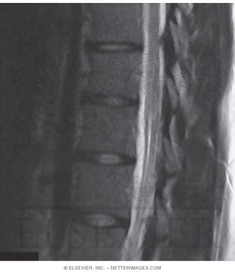 Ligamentum Flavum
