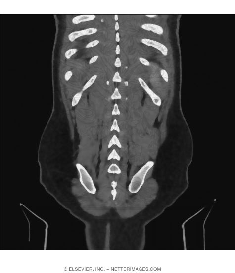 Back, Lower Paraspinal Muscles