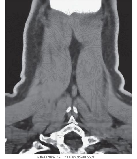 Watermarked preview of unlabeled image: Semispinalis Capitis