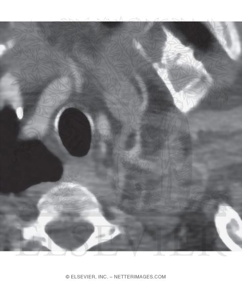 Watermarked preview of unlabeled image: Thoracic Duct