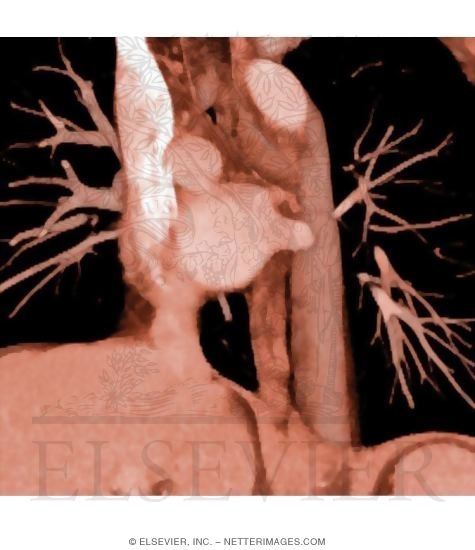 Thoracic Esophagus