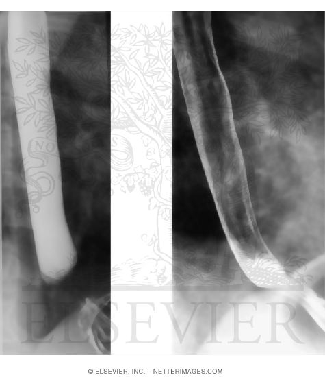 Esophagogastric Junction