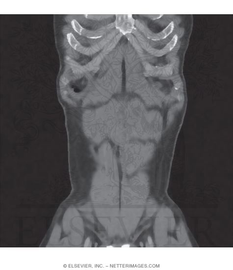 Rectus Abdominis