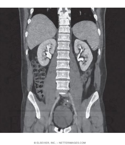 Psoas Major