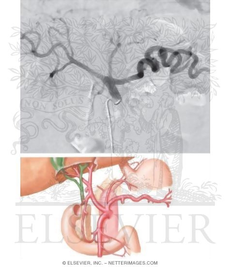 Watermarked preview of unlabeled image: Celiac Trunk, Normal and Variant