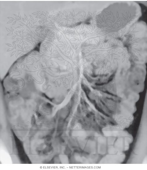Watermarked preview of unlabeled image: Arteries of the Small Bowel