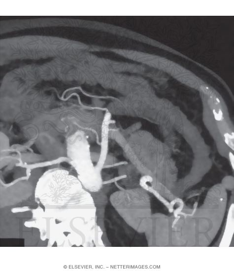 Marginal Artery (of Drummond)