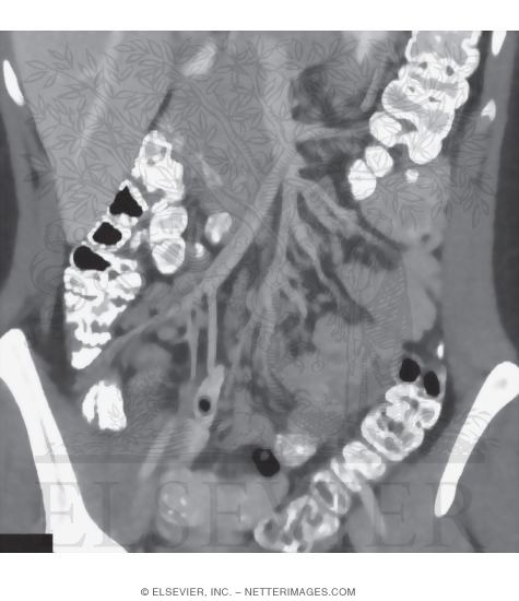 Mesenteric Lymph Nodes
