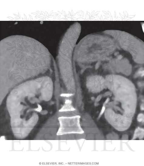 Suprarenal (Adrenal) Glands and Kidneys