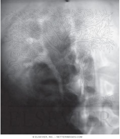 Renal Pelvis