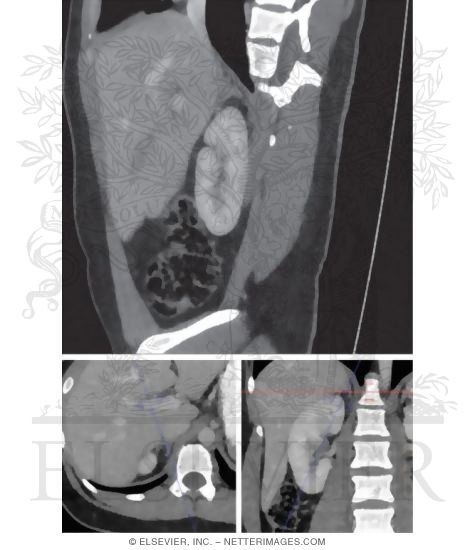 Kidney, Oblique Sagittal Section