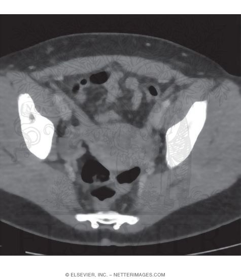 Female Pelvis, Round Ligament, and Ovary